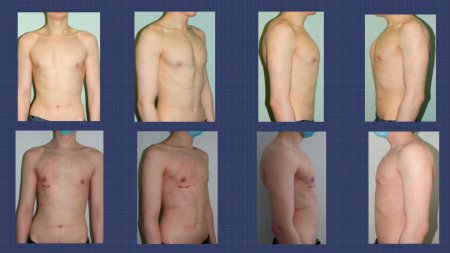 Деформация грудной клетки килевидная