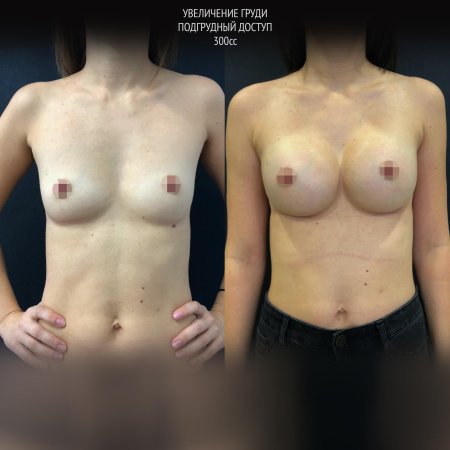 Пластика груди