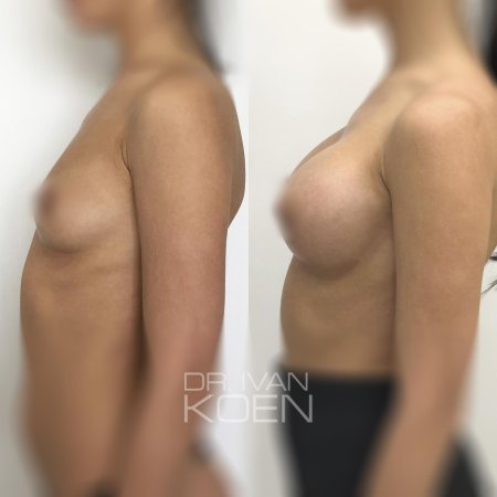 Пластика груди