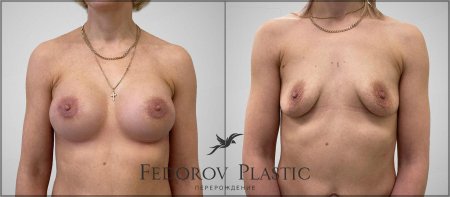 Гинекомастия операция