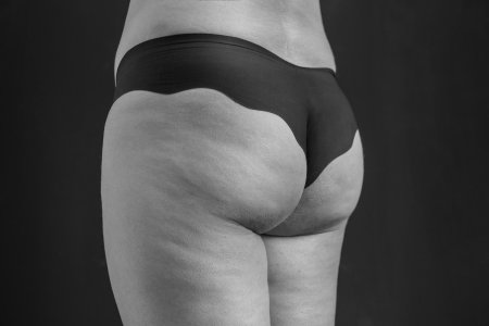 Целлюлит на ягодицах