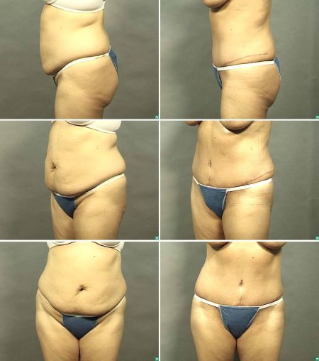 Реверсивная абдоминопластика