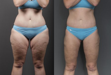 Липосакция живота