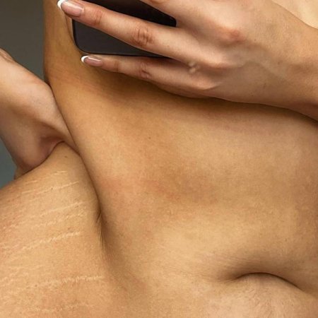 Жировая складка