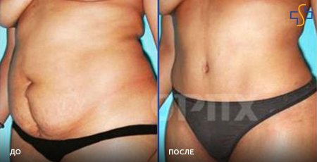 Абдоминопластика миниабдоминопластика живота