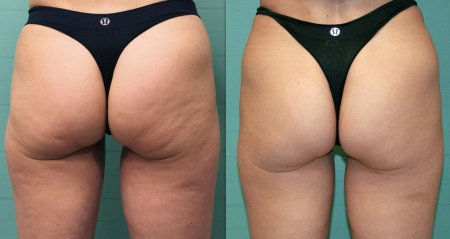 Липодистрофия целлюлит