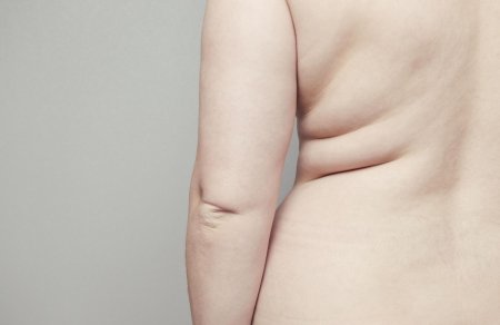 Складки на спине