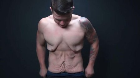 Обвисла кожа после похудения