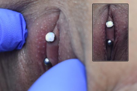 Genital piercing