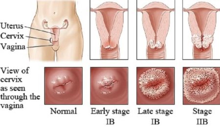 Зппп остроконечные кондиломы