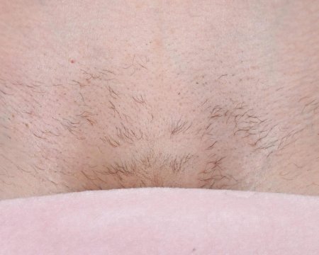 Волос на лобке