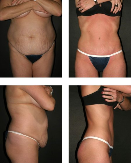 Абдоминопластика лилия нилова