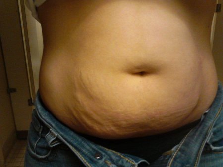 Растяжки после беременности на животе