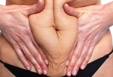 Обвисшая кожа