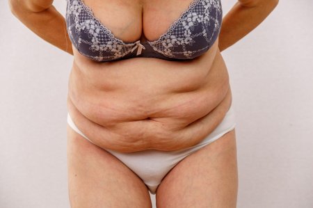 Пластика живота