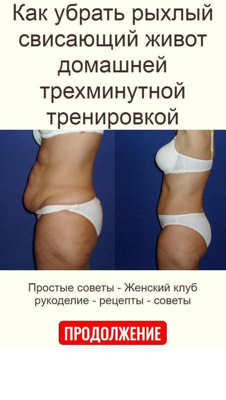 Свисающий живот