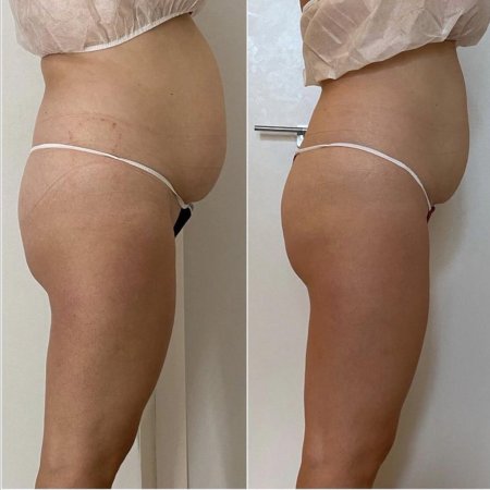 Безоперационная липосакция