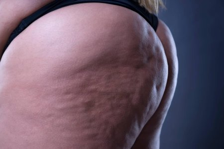 Женщина с целлюлитом