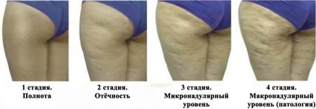 Целлюлит 1 стадия