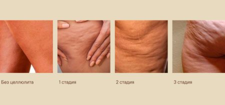 Целлюлит 2 стадия