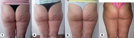 Антицеллюлитный массаж до и после