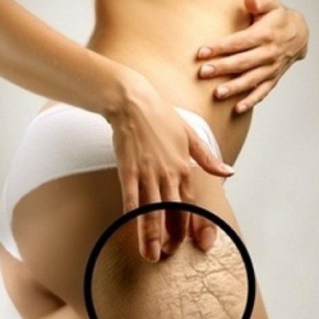 Растяжка на теле