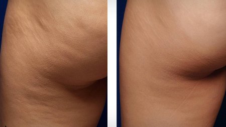 Кавитация целлюлит