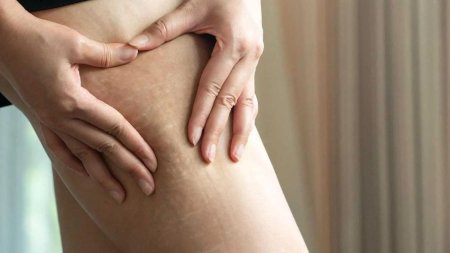 Целлюлит и растяжки