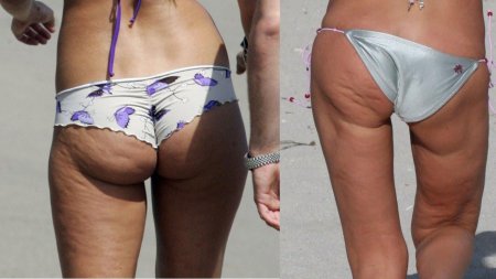 Липодистрофия целлюлит