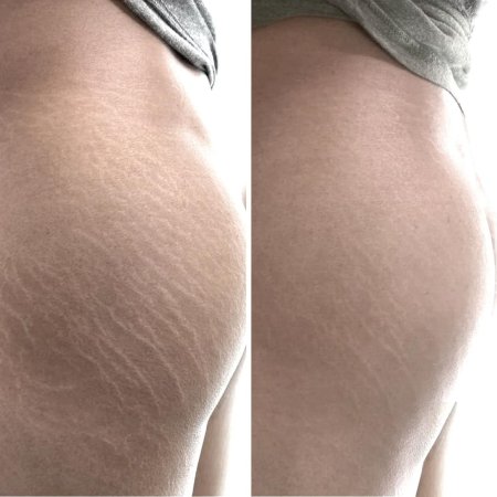 Стрии растяжки