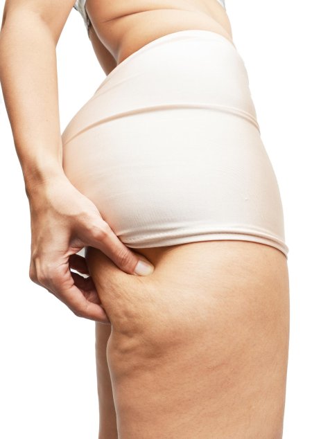 Целлюлит на бедрах