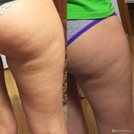 Антицеллюлитный массаж результаты