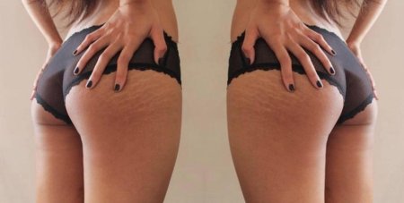 Растяжка на попе