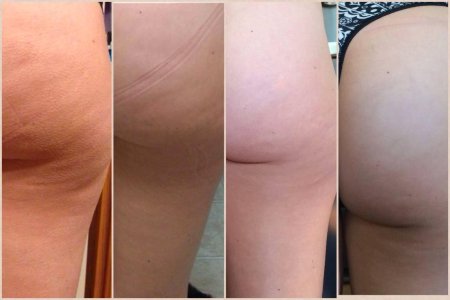 Липодистрофия целлюлит
