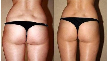 До и после антицеллюлитного массажа