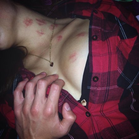 Засос на груди