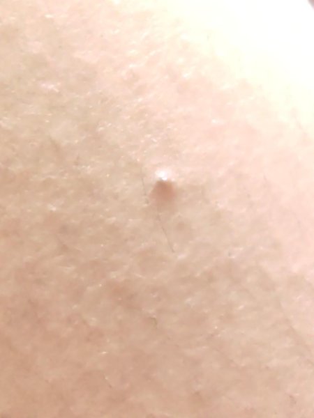 Белая папиллома