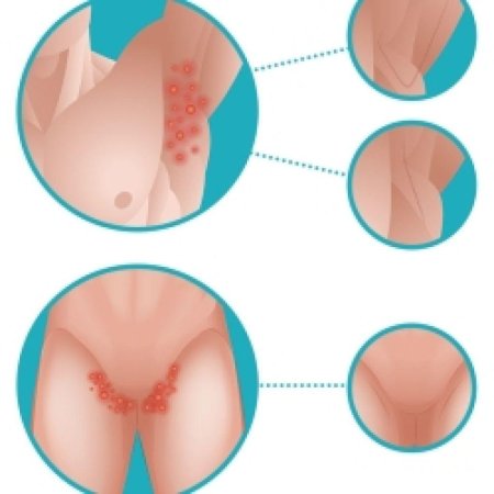 Остроконечные кондиломы впч