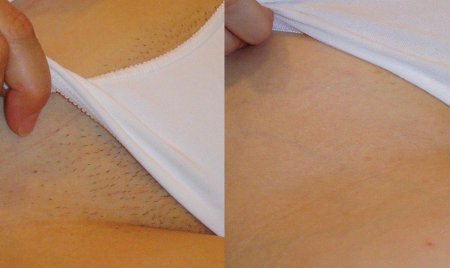 Эпиляция лазером глубокое бикини