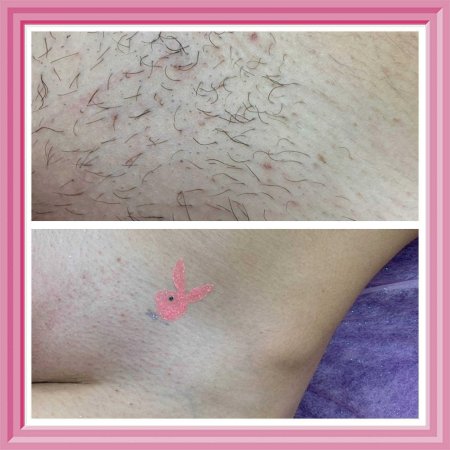 Эпиляция бикини