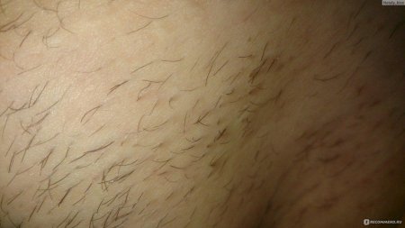 Эпиляция лобковых волос