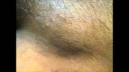 Паховый гидраденит