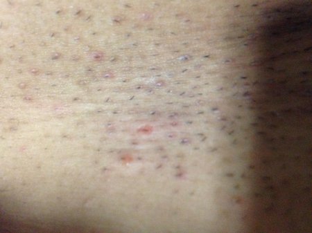 Прыщики после бритья