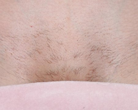 Зона бикини эпиляция классическое
