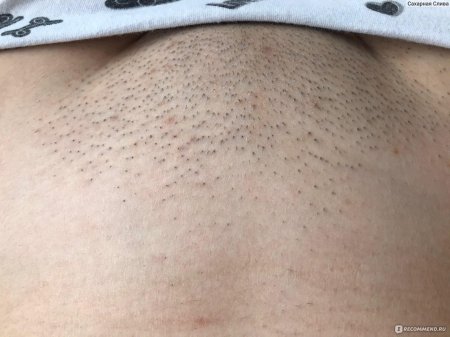 Лазерная депиляция зоны бикини