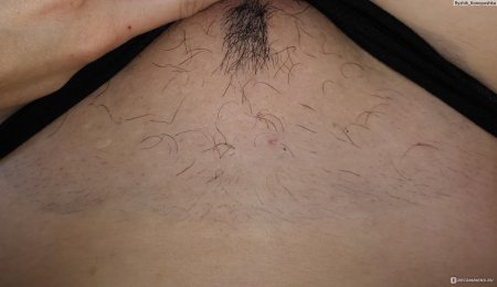 Электроэпиляция бикини глубокое