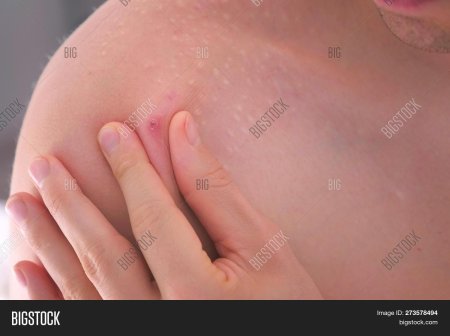 Плотный прыщик