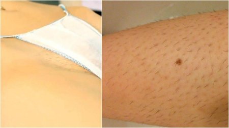 Лазерная эпиляция бикини