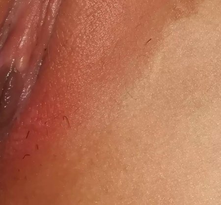 Белые прыщики на вагине