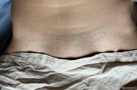 Лазерная эпиляция глубокого бикини